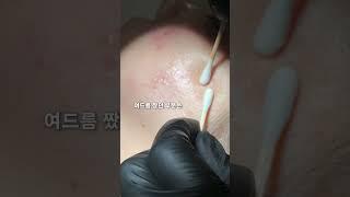 사춘기에도 없던 좁쌀 여드름이 나이 40에 턱과 입주변에 자주 생겨 스트레스가 이만저만이 아닌 40대 정은 님 속에서치밀어 오르는화를 감추지 못하고 그만.. #피부관리
