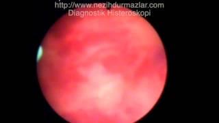 Diagnostik Histeroskopi - Diagnostic Hysteroscopy