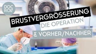 BRUSTVERGRÖSSERUNG mit 300ML BRUSTIMPLANTATEN- die OP bei Dr. Bartsch