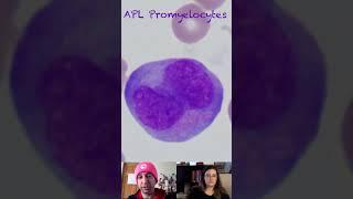 Morphological Characteristics of Promyelocytes in Acute Promyelocytic Leukemia (APL)