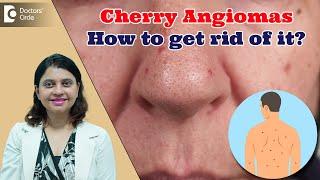 RED DOTS ON SKIN | Cherry Angioma & its Treatment | Red Moles - Dr. Amee Daxini | Doctors' Circle