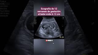 EMBARAZO DE 12 SEMANAS EL BEBÉ MIDE 6 CM