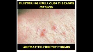 5d  Dermatitis Herpetiformis