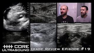 Core Ultrasound Image Review, Episode 19