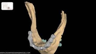 Mastering Dental Bar Design with Telescopic Attachments in Exocad