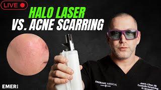 HALO LIVE FOR DEEP ACNE SCARS | Dr. Jason Emer