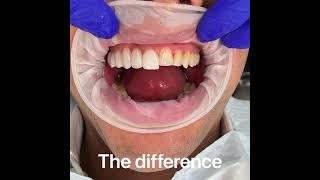 12 non-cutting veneers! What a case, what a difference!