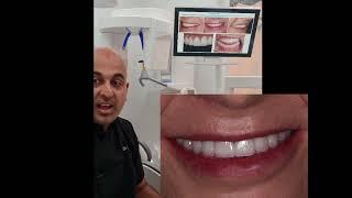 Life Changing Smile Design with 28 Feldspathic Veneers. Zero Damage to the Natural Teeth.