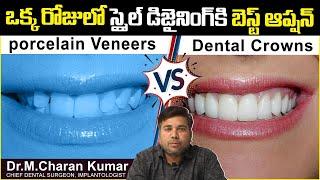 ఒక్క రోజులో స్మైల్ డిజైనింగ్ | Dental Crowns Vs Porcelain Veneers Telugu | Eledent Dental Hospitals