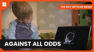 Born With 2% Brain, Now Defying Science | The Boy With No Brain