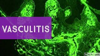 Vasculitis...Explained by a Dermatopathologist