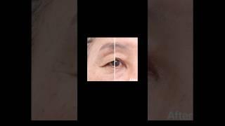 눈 2배 커진 60대 중년 #상안검수술