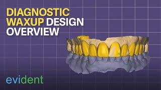 Diagnostic Waxup Design Overview with Exocad| Evident Digital | Dental CAD Design