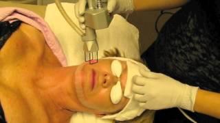 CO2 Fractional Resurfacing