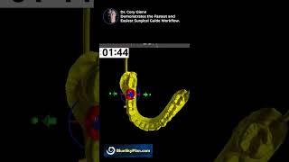 Surgical Guide AI Workflow!  #blueskyplan #surgicalguide #implantology #dentaleducation #dentistry