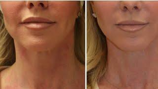 GuancheLift: Facelift Without Surgery