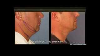 Liposuction Before and After of Neck Area | Silk Touch Medical Aesthetics, Boise