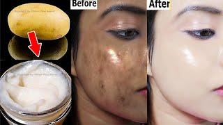 1 Day Challenge - Dark Skin Gone | Remove Hyperpigmentation From Face