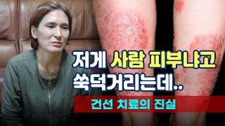 [psoriasis]건선 때문에 삶을 포기하고 싶었던적이 한두번이 아니예요.