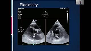 Joint Echo Conference: Mitral Stenosis