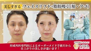 【仕上がりの美しさが違います！】フェイスリフト(トータル)＋脂肪吸引(頬・アゴ)の施術と症例 ／MIYAフェイスクリニック