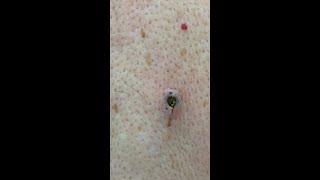 Big Blackhead Removal (DPOW) | CONTOUR DERMATOLOGY #shorts