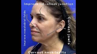 Reno Mini-Facelift with Neck Lift under Local Anesthesia | Avance Plastic Surgery Institute