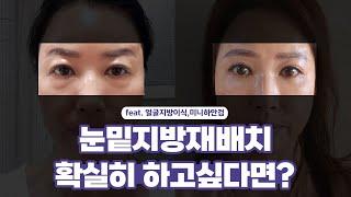 눈밑지방재배치 확실히 하고싶다면?