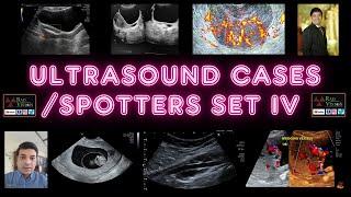 ULTRASOUND SPOTTERS AND CASES SET IV