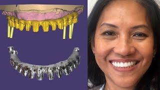 The Most Difficult Full Mouth Implant Case | Part 1