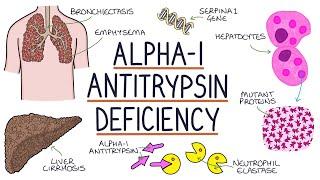 Understanding Alpha-1 Antitrypsin Deficiency