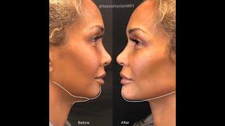 Non-Surgical Chin Contouring by Dr. Simon Ourian