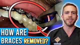 How Are Braces Removed?