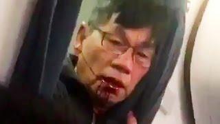 United Airlines Dr David Dao Reveals Horrific Injuries & Lawsuit