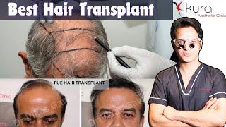 Remarkable Hair Transplant Journey | Best Hair Transplant in Punjab at Kyra Aesthetic Clinic