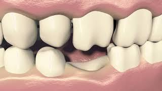 Affordable Dental Bridges in Dubai | Bellaviso Medical Center