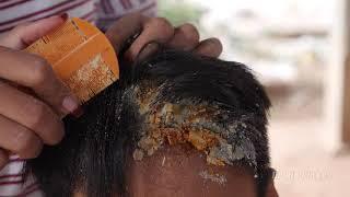 Removing Huge Dandruff!! (Big Flakes) | The Best Scalp Scratching and Picking #110