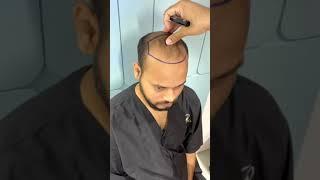 Hair Transplant Clinic in Surat | Dr. Vivek Galani's RQC Hospital