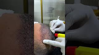 First Shampoo Headwash after Hair Transplant | Cara Clinic