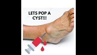 Dr Sho Drains a FOOT CYST!!!