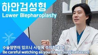 하안검, Lower blepharoplasty