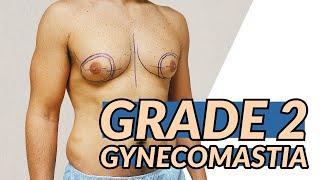 Grade 2 Gynecomastia Surgery with Dr. Dadvand