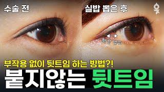 붙지않는 3D 뒤트임! 부작용 뒤트임하는 방법