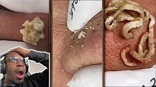 Satisfying Pimple pop and Blackheads Removal Compilation 44 (REACTION)