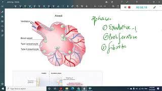 Acute respiratory distress syndrome || Medicine