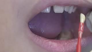 Fluoride Varnish Application