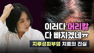 탈모까지 부르는 지루성피부염 때문에 매일이 고통이였지만..