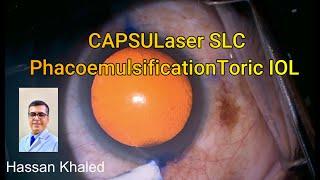 CAPSULaser SLC , PhacoemulsificationToric IOL