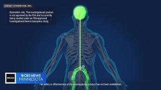 M Health Fairview testing new procedure, aiming to improve long-term pain relief