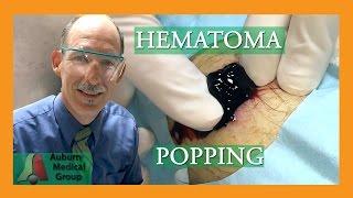 Hematoma Popping | Auburn Medical Group